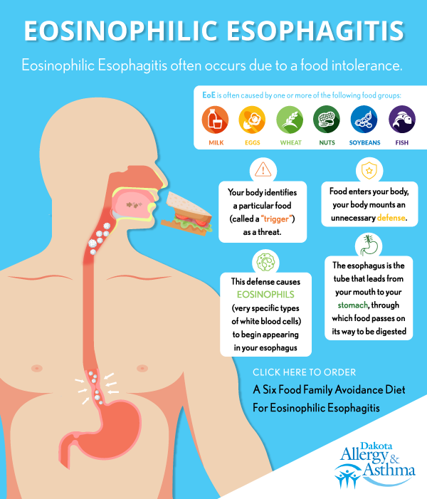 Eosinophilic Esophagitis Infographic_vs9_600 x 700